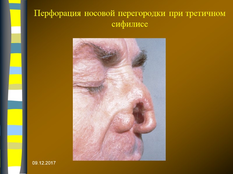 Перфорация носовой перегородки при третичном сифилисе  09.12.2017